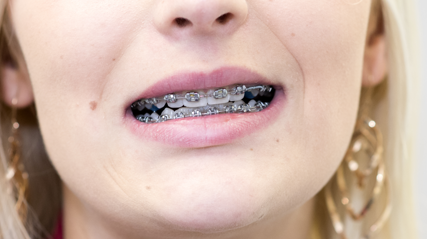 Ung kvinna med fast tandställning