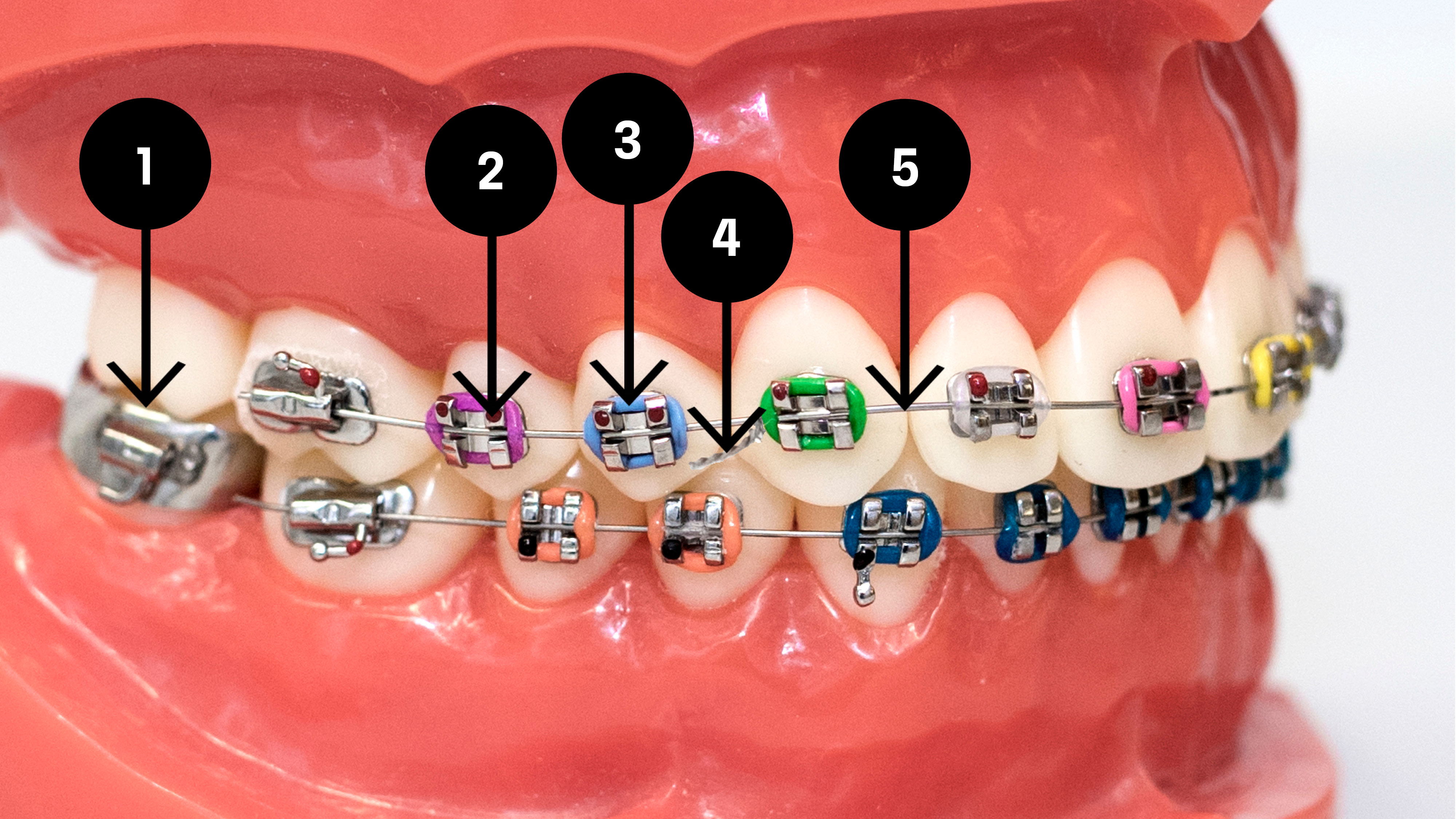 En tandställnings olika delar. 1. Band, 2. Bracket (det gummiringarna sitter på), 3. Gummiring (de färgade ringarna), 4. Ståltråd, 5. Båge